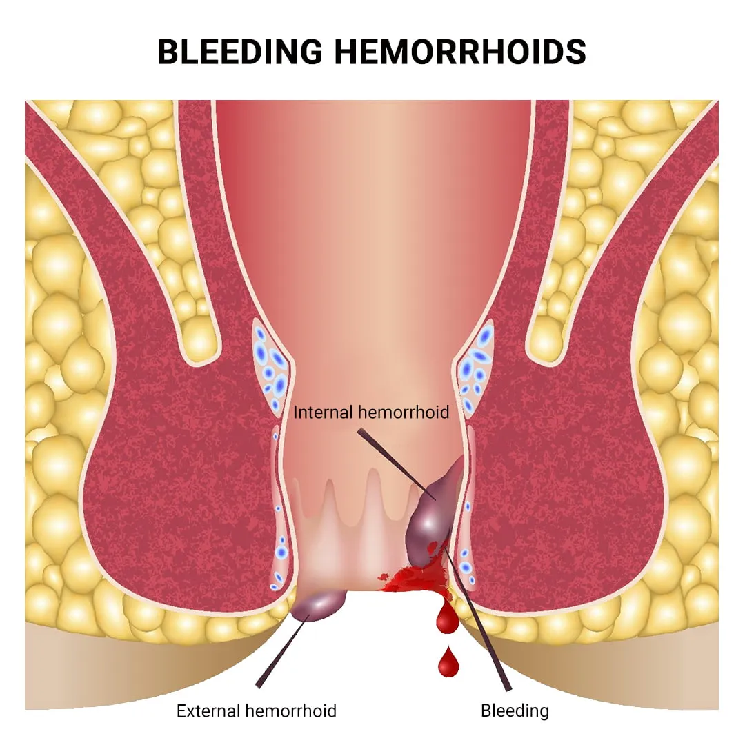 can glp 1 cause rectal bleeding Top Signs and Symptoms of a Thrombosed Hemorrhoid