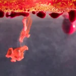 Is Infrared Coagulation Right for Your Hemorrhoids?